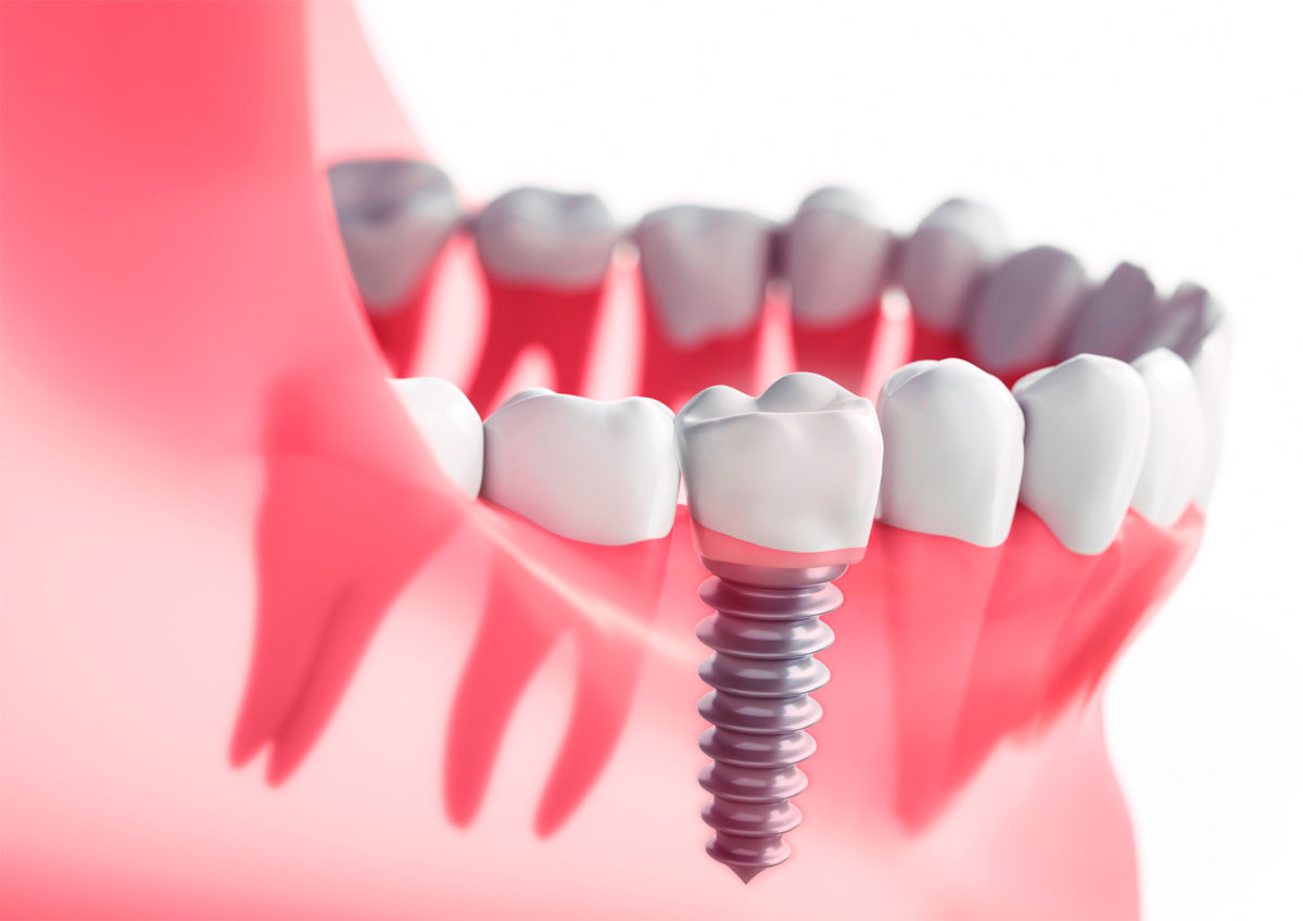 implante dental Ledesma Clinica Dental en Villanueva de la Cañada
